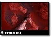 Foto de um aborto - 8 semanas