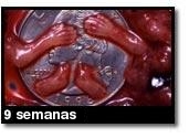Foto de um aborto - 9 semanas